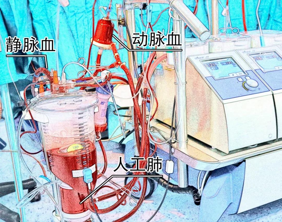 体外循环要不要了解一下?